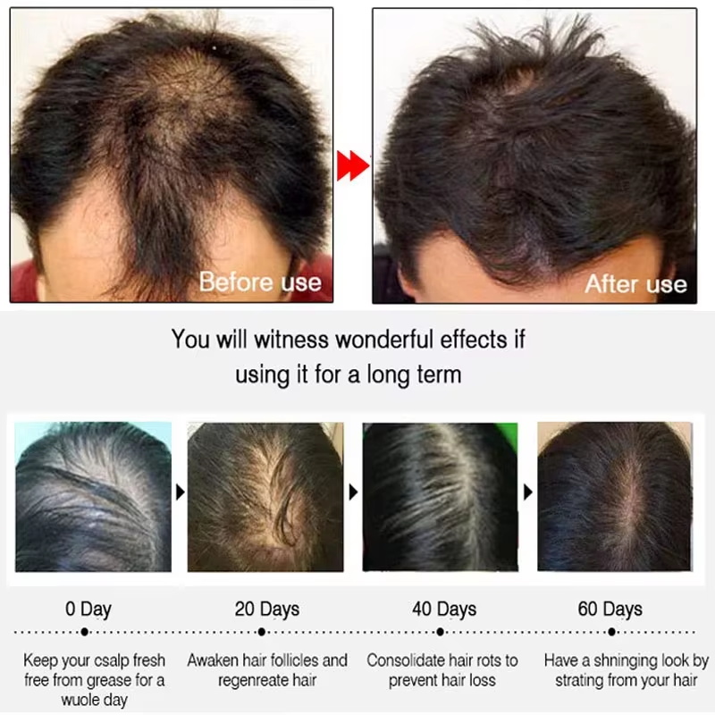 速効性ジンジャーヘアグローススプレー、毛根育成、脱毛防止、育 - Hair Care For Hair Growth のレビューと価格